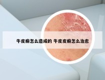 牛皮癣怎么造成的 牛皮皮癣怎么治愈