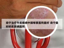 南宁治疗牛皮癣病中国哪里医院最好 南宁最好的皮肤病医院