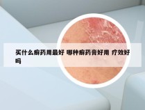 买什么癣药用最好 哪种癣药膏好用 疗效好吗