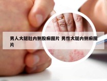 男人大腿肚内侧股癣图片 男性大腿内侧癣图片