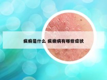 疯癣是什么 疯癫病有哪些症状