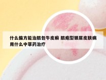 什么偏方能治脓包牛皮癣 脓疱型银屑皮肤病用什么中草药治疗