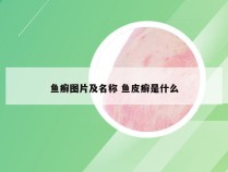 鱼癣图片及名称 鱼皮癣是什么