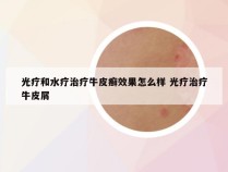 光疗和水疗治疗牛皮癣效果怎么样 光疗治疗牛皮屑