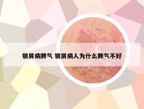 银屑病脾气 银屑病人为什么脾气不好