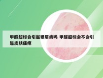 甲醛超标会引起银屑病吗 甲醛超标会不会引起皮肤瘙痒