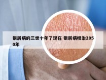 银屑病的三世十年了现在 银屑病根治2050年