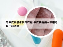 与牛皮癣患者同穿衣服 牛皮肤癣病人衣服可以一起洗吗