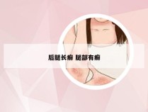 后腿长癣 腿部有癣