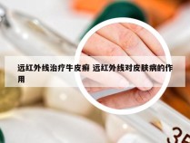 远红外线治疗牛皮癣 远红外线对皮肤病的作用