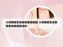 小孩鳞屑型皮肤癣是啥原因 小孩鳞屑型皮肤癣是啥原因造成的