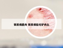 银屑病鹿肉 银屑病能吃驴肉么