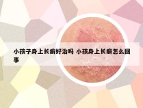 小孩子身上长癣好治吗 小孩身上长癣怎么回事