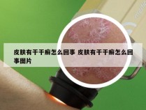 皮肤有干干癣怎么回事 皮肤有干干癣怎么回事图片