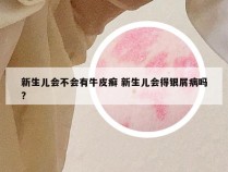 新生儿会不会有牛皮癣 新生儿会得银屑病吗?