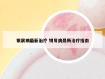 银屑病最新治疗 银屑病最新治疗指南