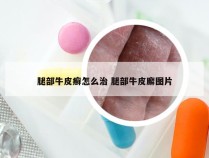 腿部牛皮癣怎么治 腿部牛皮廨图片