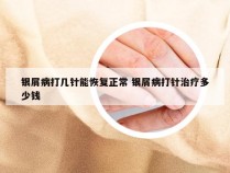 银屑病打几针能恢复正常 银屑病打针治疗多少钱