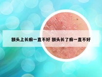 额头上长癣一直不好 额头长了癣一直不好