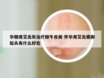 孕期用艾灸灰治疗脚牛皮癣 怀孕用艾灸熏脚趾头有什么好处