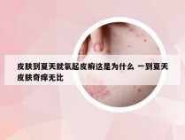 皮肤到夏天就氧起皮癣这是为什么 一到夏天皮肤奇痒无比