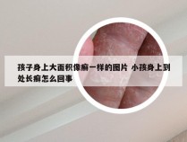 孩子身上大面积像癣一样的图片 小孩身上到处长癣怎么回事