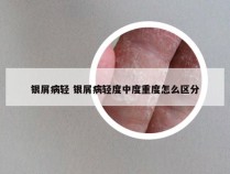 银屑病轻 银屑病轻度中度重度怎么区分