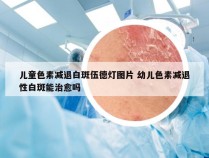 儿童色素减退白斑伍德灯图片 幼儿色素减退性白斑能治愈吗