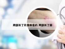 跨部长了片像癣是的 胯部长了藓