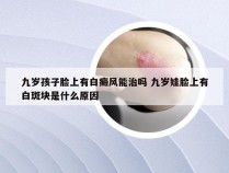 九岁孩子脸上有白癜风能治吗 九岁娃脸上有白斑块是什么原因