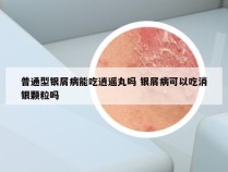 普通型银屑病能吃逍遥丸吗 银屑病可以吃消银颗粒吗