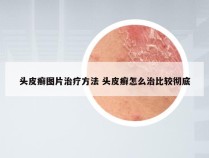 头皮癣图片治疗方法 头皮癣怎么治比较彻底