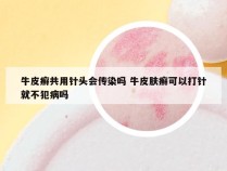 牛皮癣共用针头会传染吗 牛皮肤癣可以打针就不犯病吗