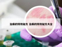 治癣的特效秘方 治癣的特效秘方大全