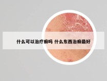 什么可以治疗癣吗 什么东西治癣最好