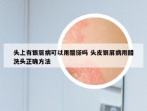 头上有银屑病可以用醋搽吗 头皮银屑病用醋洗头正确方法