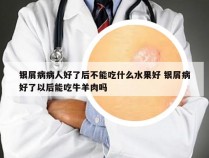 银屑病病人好了后不能吃什么水果好 银屑病好了以后能吃牛羊肉吗