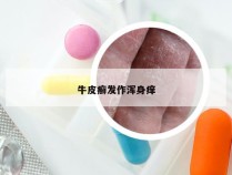 牛皮癣发作浑身痒