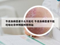 牛皮血癣患者什么不能吃 牛皮血癣患者不能吃啥北京仲博医院地铁站