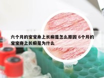 六个月的宝宝身上长癣是怎么原因 6个月的宝宝身上长癣是为什么