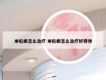 米粒癣怎么治疗 米粒癣怎么治疗好得快