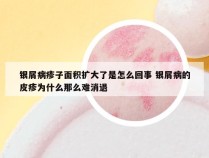 银屑病疹子面积扩大了是怎么回事 银屑病的皮疹为什么那么难消退