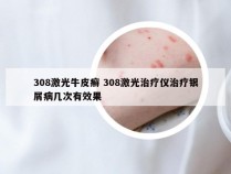 308激光牛皮癣 308激光治疗仪治疗银屑病几次有效果