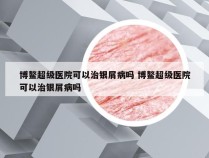 博鳌超级医院可以治银屑病吗 博鳌超级医院可以治银屑病吗