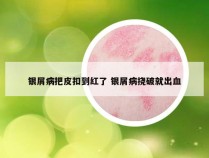 银屑病把皮扣到红了 银屑病挠破就出血