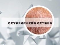 达克宁软膏可以治皮肤癣 达克宁能治癣