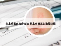 头上癣怎么治疗方法 头上有癣怎么治能除根