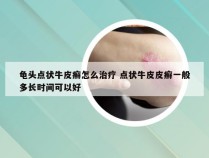 龟头点状牛皮癣怎么治疗 点状牛皮皮癣一般多长时间可以好