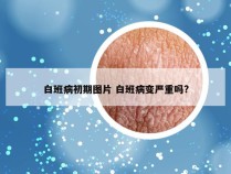 白班病初期图片 白班病变严重吗?