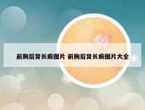 前胸后背长癣图片 前胸后背长癣图片大全